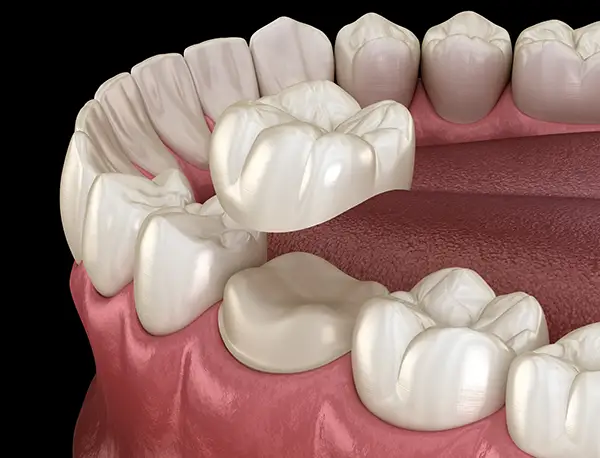 Diagram of a porcelain dental crown from Capitol Square Dental 