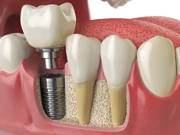 Model of a dental implant from Capitol Square Dental 