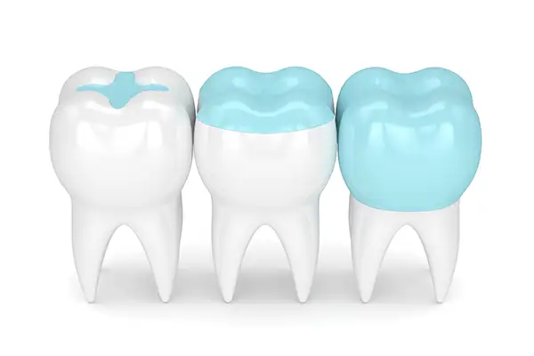 Diagram of inlays and onlays from Capitol Square Dental 