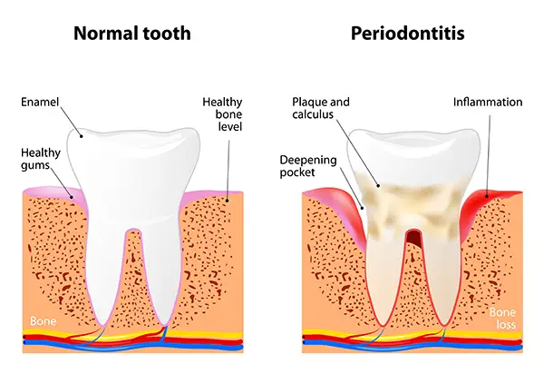 Diagram of gum disease from Capitol Square Dental 