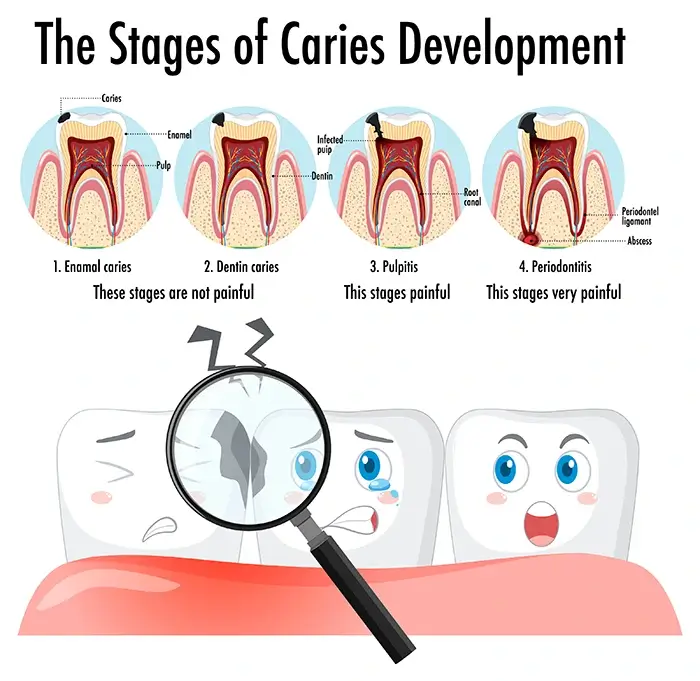 The stages of Caries Development for a tooth