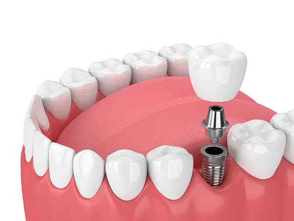 Dental Implant diagram from Capitol Square Dental 