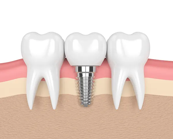 Diagram of a dental implant from Capitol Square Dental