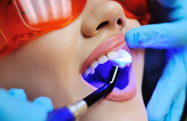 Close up of a dental assistant applying a UV light to a patient's newly sealed teeth