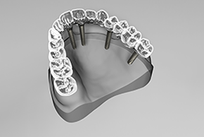 All-On-6 Dental Implant